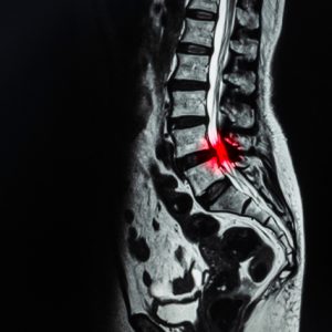 Spinal Stenosis is a serious condition that affects the back and spine.
